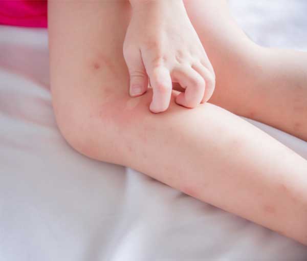 If you are suffering from bed bug bites, you can thankfully treat them right at home. Find out how from Terminix Anderson